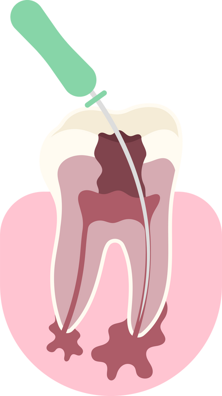 canal wisdom root implant planing crown scaling tooth dental decay procedure bridge clinic anatomy medical pulp treat pain whitening filling pus cavity hygiene Abscesses gum